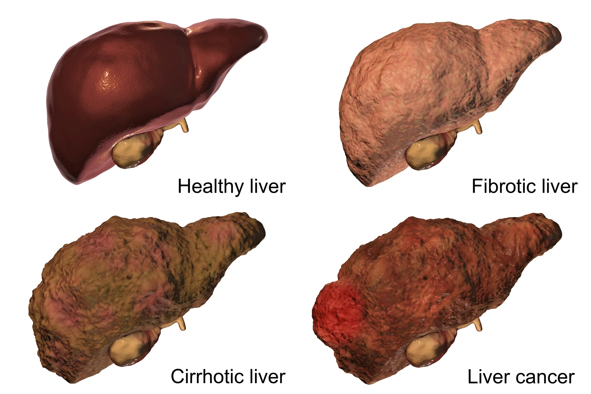 At least 90% of patients with liver cancer are related to liver cirrhosis caused by chronic hepatitis B or C, or excessive-drinking liver disease. In the so-called three-step procedure of “chronic hepatitis →liver cirrhosis→ liver cancer,” the probability of liver cancer generation caused by the DNA or RNA of virus or related protein directly is smaller, while majority is related to the repeated and chronic necrosis-based inflammation in liver. The out-of-control repair later leads to the generation of liver cancer and is related to the timeline and age when suffering the disease