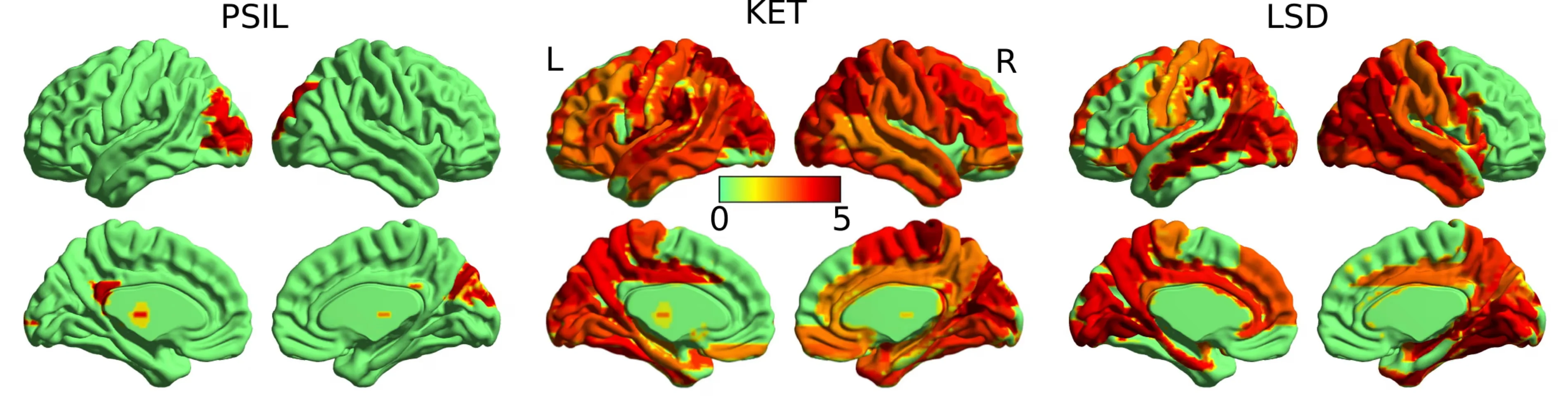 Brain activity with (left to right) psilocybin, ketamine and LSD. The red areas indicate higher levels of random brain activity than normal. Photograph: Suresh Muthukumaraswamy