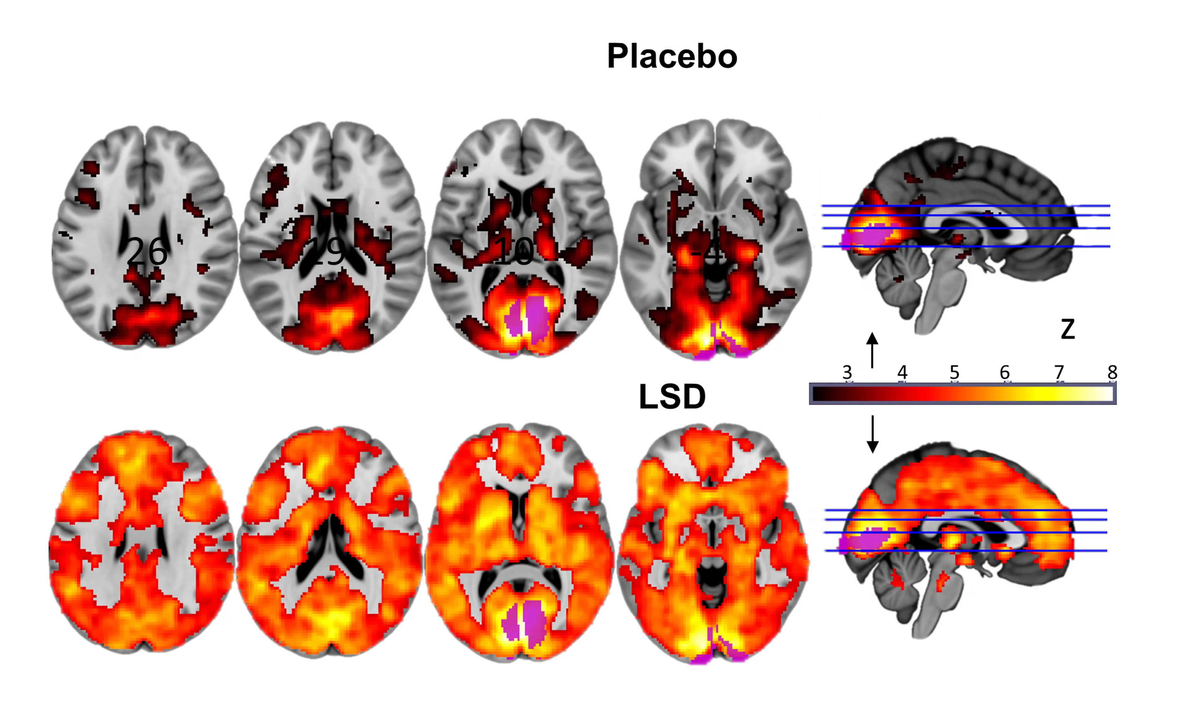 A second image shows different sections of the brain, either on placebo, or under the influence of LSD (lots of orange). Photograph: Imperial/Beckley Foundation