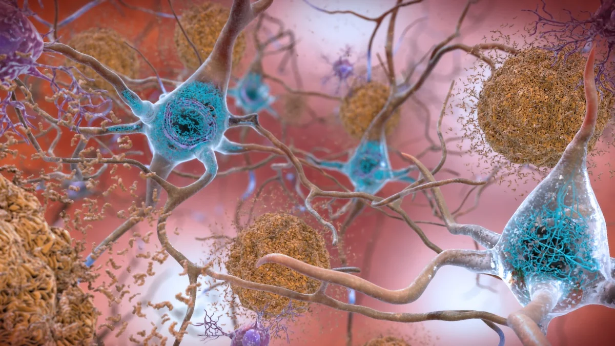 In Alzheimer's, abnormal proteins clump together to form plaques between cells (brown) and inside cells (blue). (NIH/Flickr)